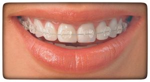 Ortodontia - Aparelho dentário