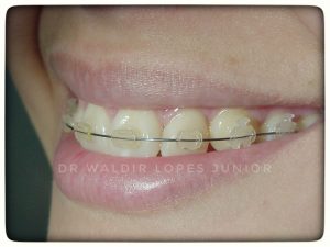Ortodontia - Aparelho dentário