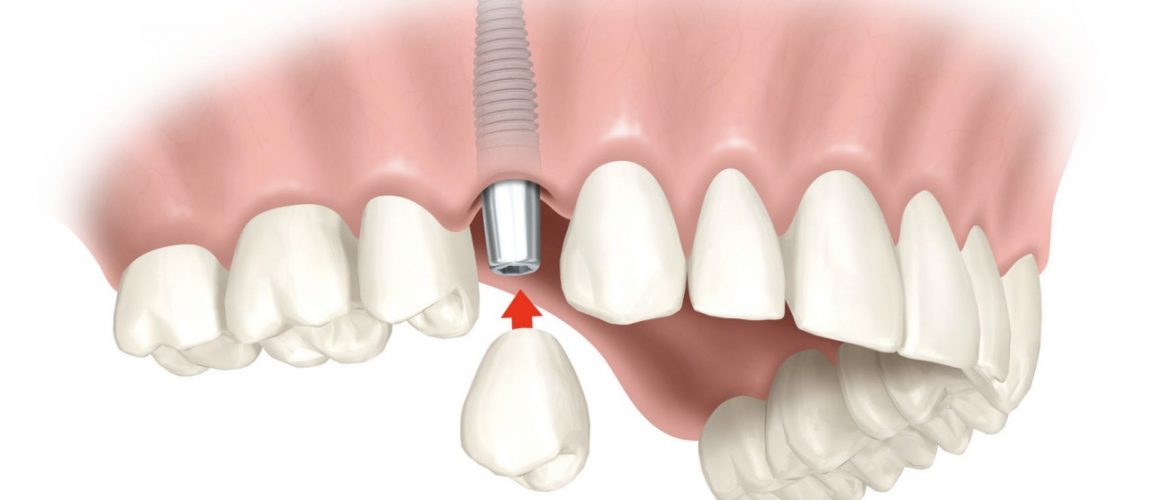 Implante dentario faz mal a saude